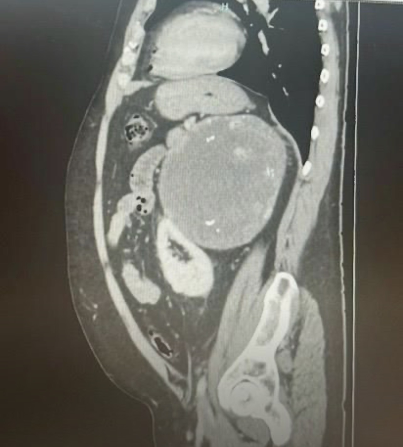 Resección de una masa suprarrenal en Hospitales Universitarios San Roque